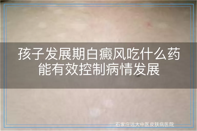 孩子发展期白癜风吃什么药能有效控制病情发展