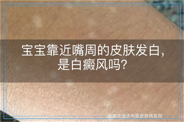 宝宝靠近嘴周的皮肤发白，是白癜风吗？