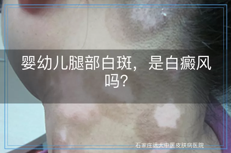 婴幼儿腿部白斑，是白癜风吗？
