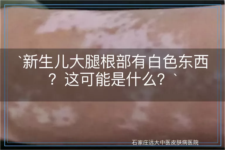 新生儿大腿根部有白色东西？这可能是什么？