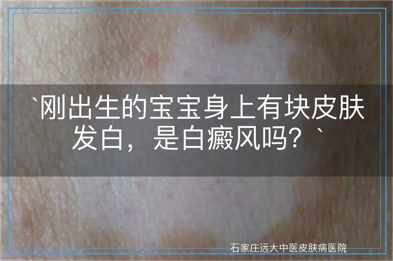 刚出生的宝宝身上有块皮肤发白,是白癜风吗?