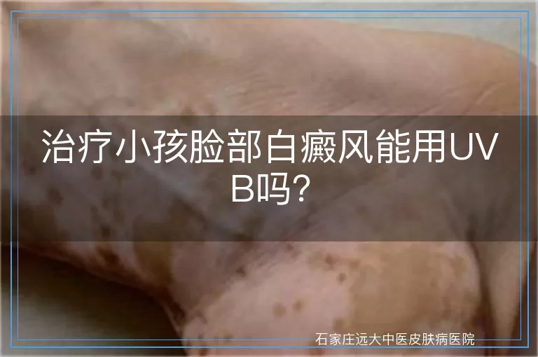 治疗小孩脸部白癜风能用UVB吗？