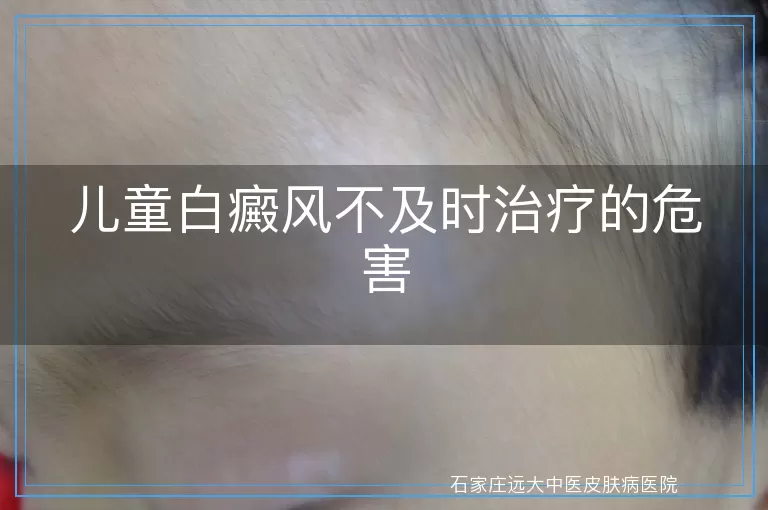 儿童白癜风不及时治疗的危害
