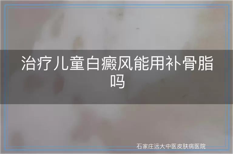 治疗儿童白癜风能用补骨脂吗