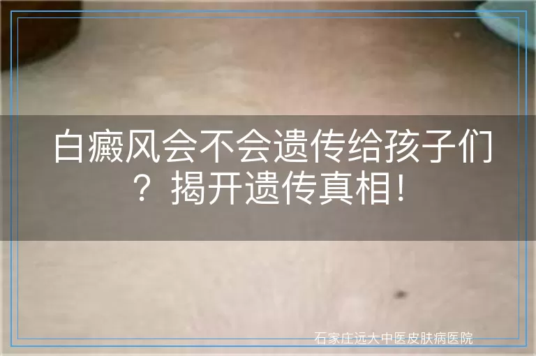 白癜风会不会遗传给孩子们？揭开遗传真相！