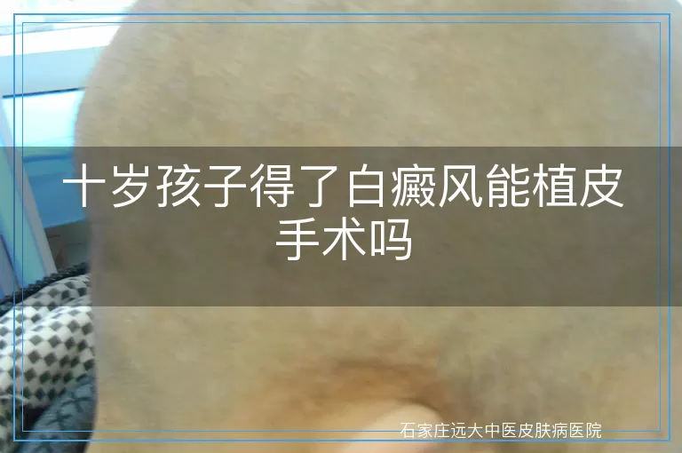十岁孩子得了白癜风能植皮手术吗