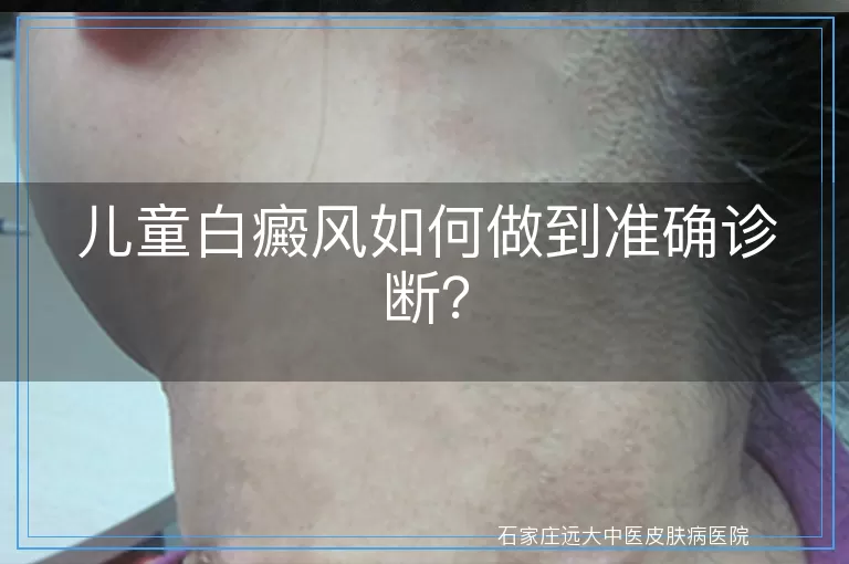儿童白癜风如何做到准确诊断？