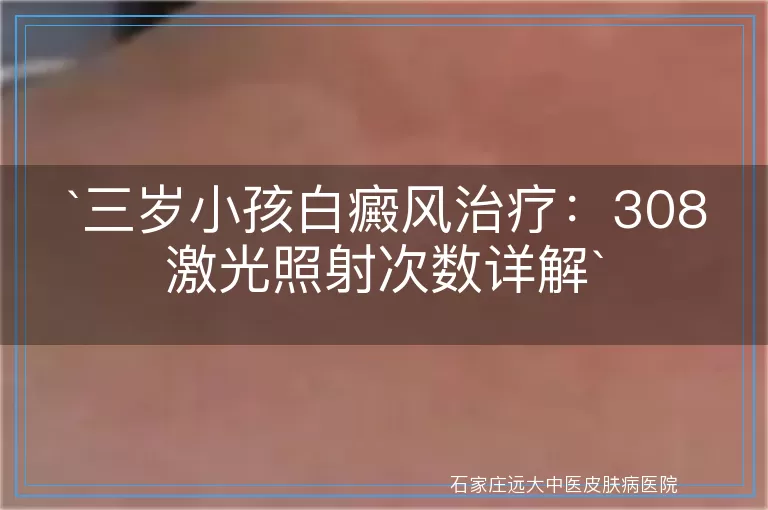 三岁小孩白癜风治疗：308激光照射次数详解