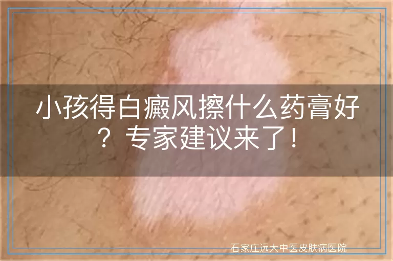 小孩得白癜风擦什么药膏好？专家建议来了！
