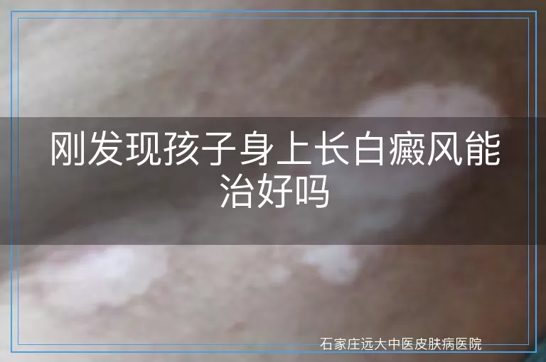 刚发现孩子身上长白癜风能治好吗