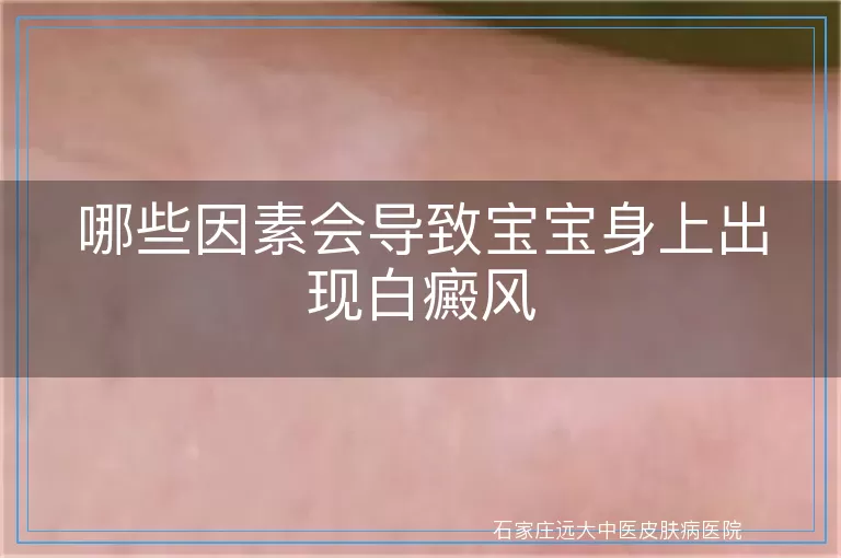 哪些因素会导致宝宝身上出现白癜风