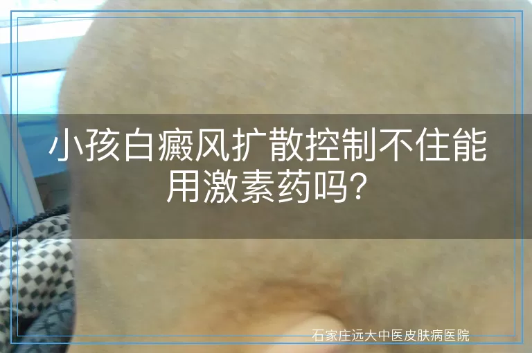 小孩白癜风扩散控制不住能用激素药吗？