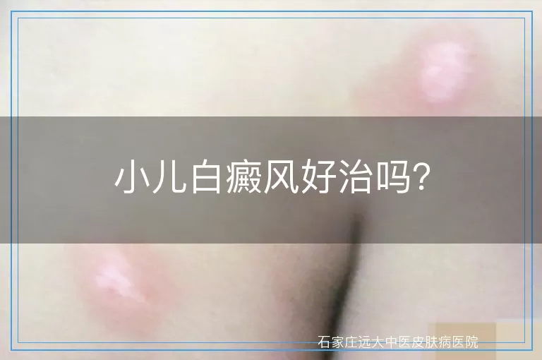 小儿白癜风好治吗？