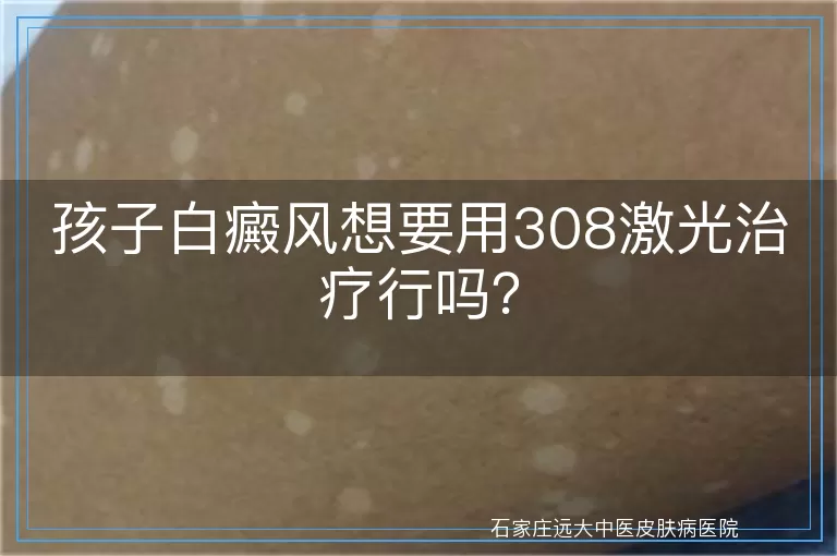 孩子白癜风想要用308激光治疗行吗？