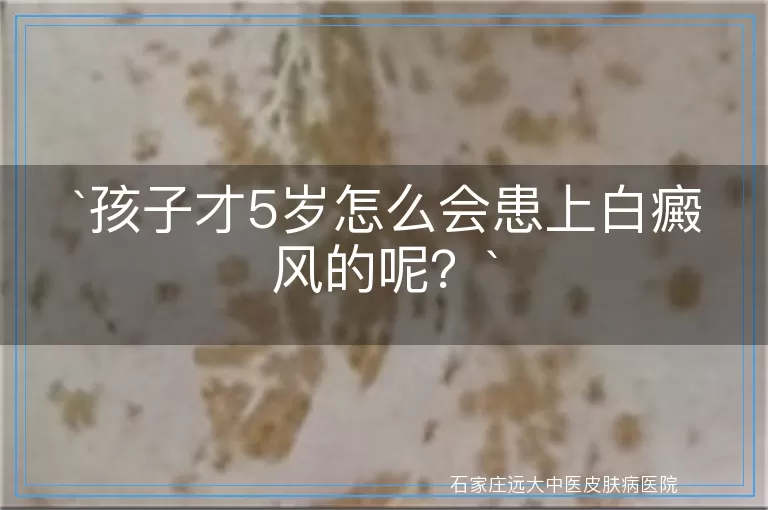 孩子才5岁怎么会患上白癜风的呢？