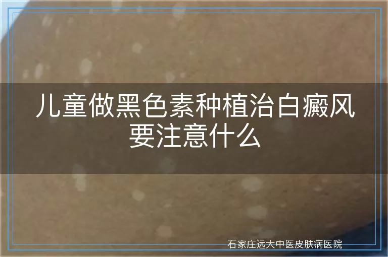 儿童做黑色素种植治白癜风要注意什么