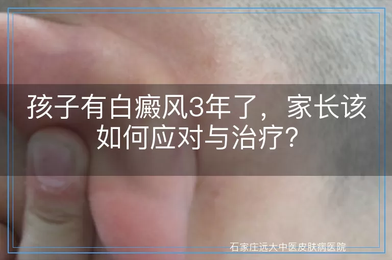 孩子有白癜风3年了，家长该如何应对与治疗？
