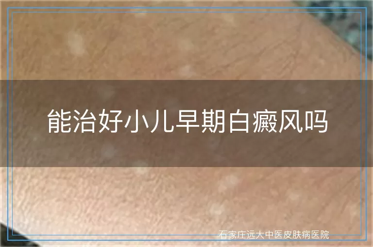能治好小儿早期白癜风吗