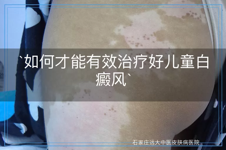 如何才能有效治疗好儿童白癜风