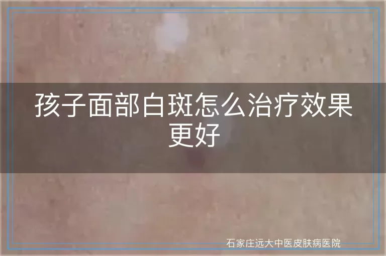 孩子面部白斑怎么治疗效果更好