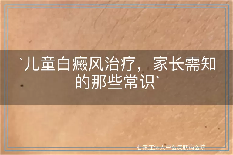 儿童白癜风治疗，家长需知的那些常识