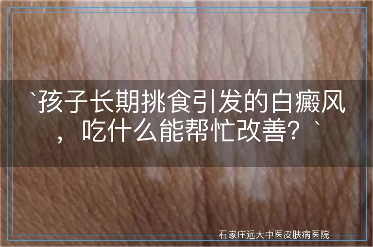 孩子长期挑食引发的白癜风，吃什么能帮忙改善？