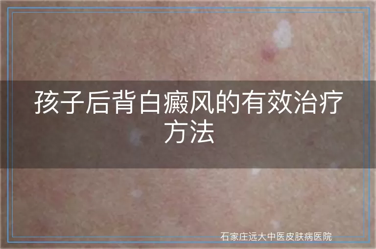 孩子后背白癜风的有效治疗方法
