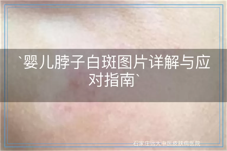婴儿脖子白斑图片详解与应对指南