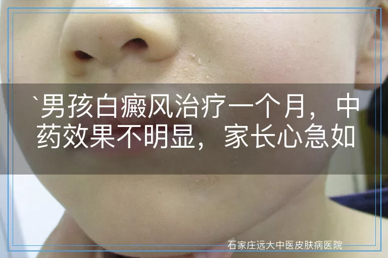 男孩白癜风治疗一个月，中药效果不明显，家长心急如焚