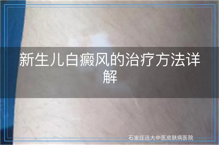 新生儿白癜风的治疗方法详解
