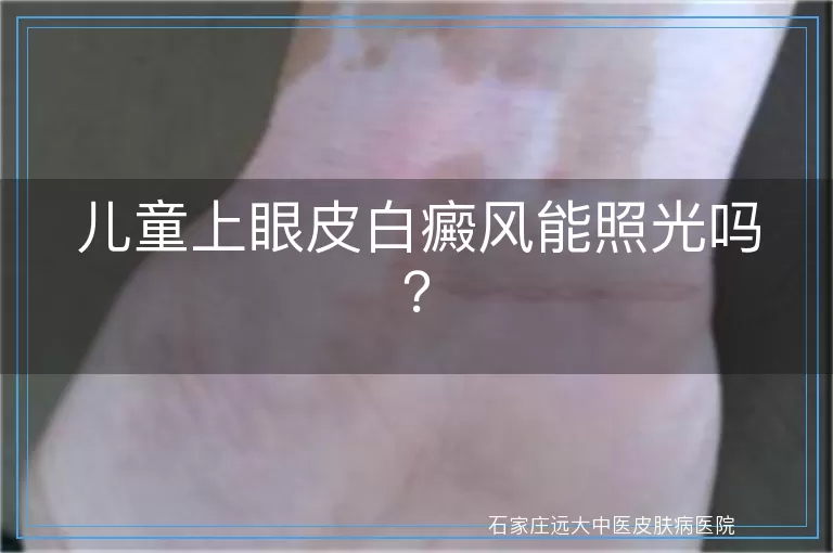 儿童上眼皮白癜风能照光吗？