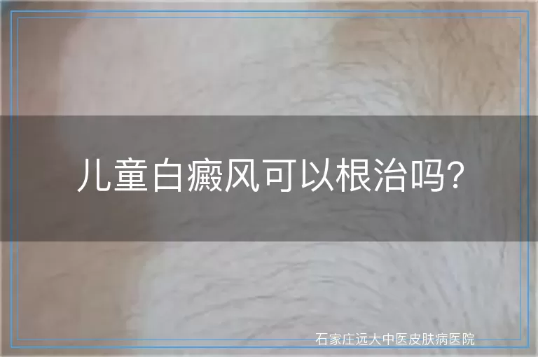 儿童白癜风可以根治吗？