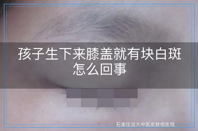 孩子生下来膝盖就有块白斑怎么回事