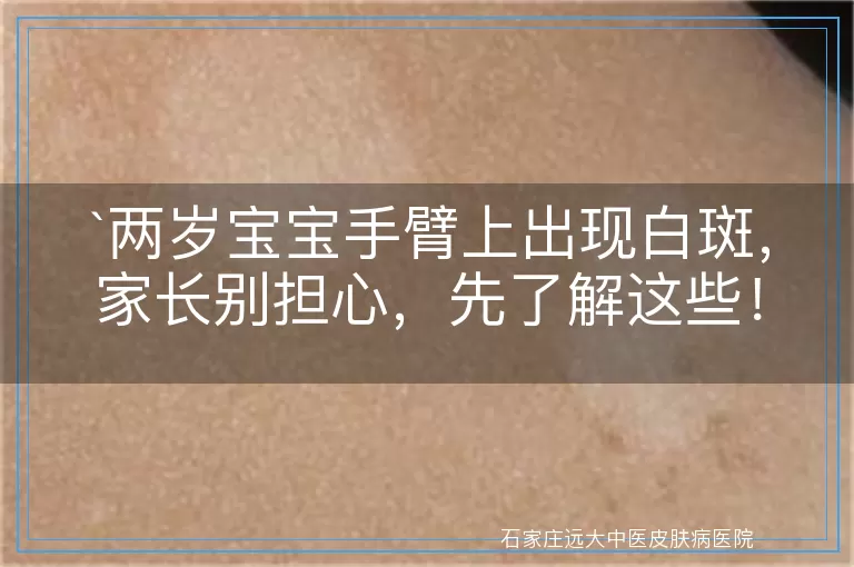 两岁宝宝手臂上出现白斑,家长别担心,先了解这些!