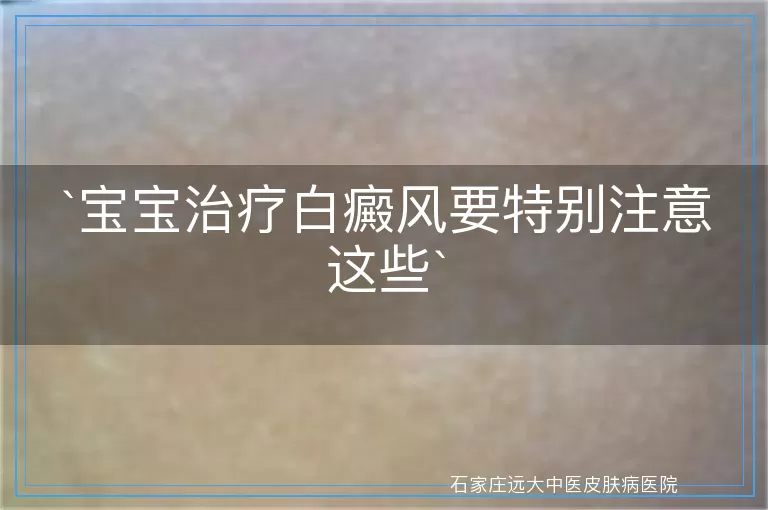 宝宝治疗白癜风要特别注意这些