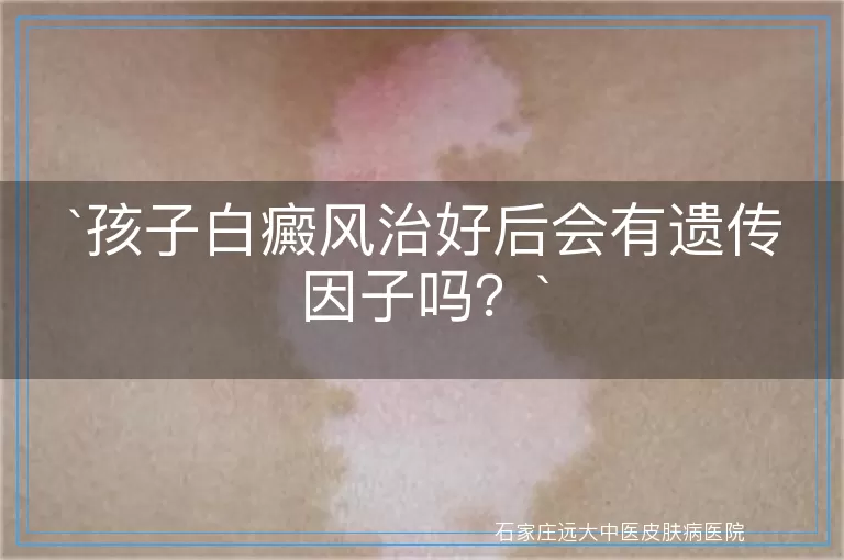 孩子白癜风治好后会有遗传因子吗？