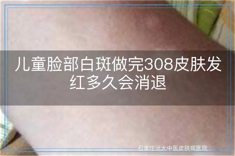 儿童脸部白斑做完308皮肤发红多久会消退