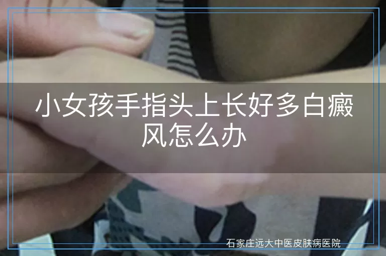 小女孩手指头上长好多白癜风怎么办