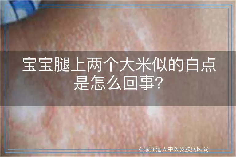 宝宝腿上两个大米似的白点是怎么回事?