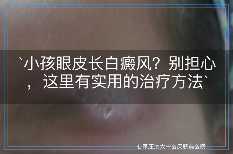 小孩眼皮长白癜风？别担心，这里有实用的治疗方法