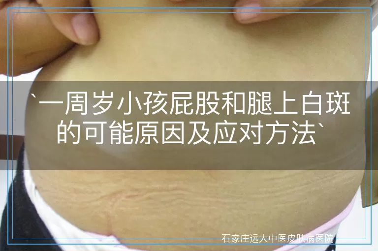 一周岁小孩屁股和腿上白斑的可能原因及应对方法