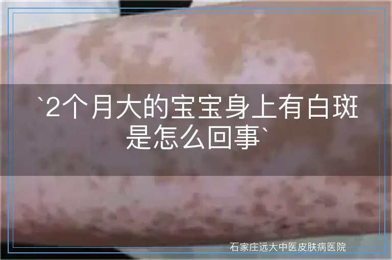2个月大的宝宝身上有白斑是怎么回事