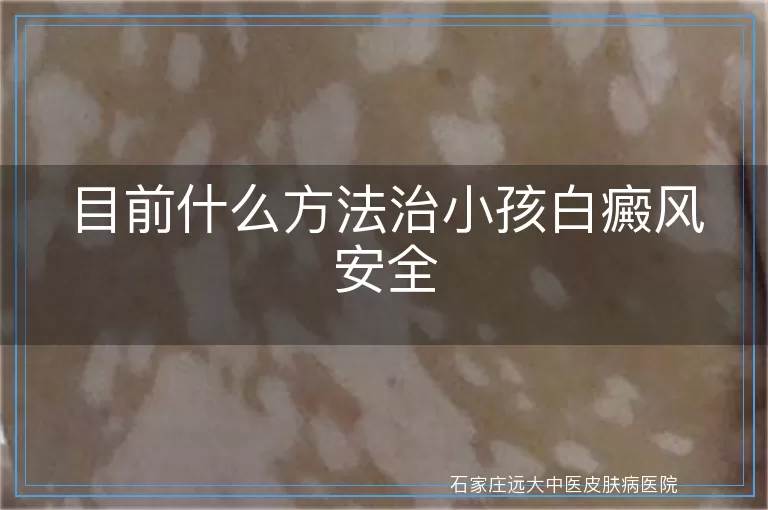 目前什么方法治小孩白癜风安全