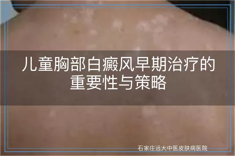 儿童胸部白癜风早期治疗的重要性与策略