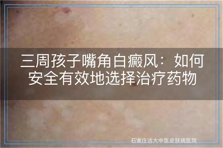 三周孩子嘴角白癜风：如何安全有效地选择治疗药物