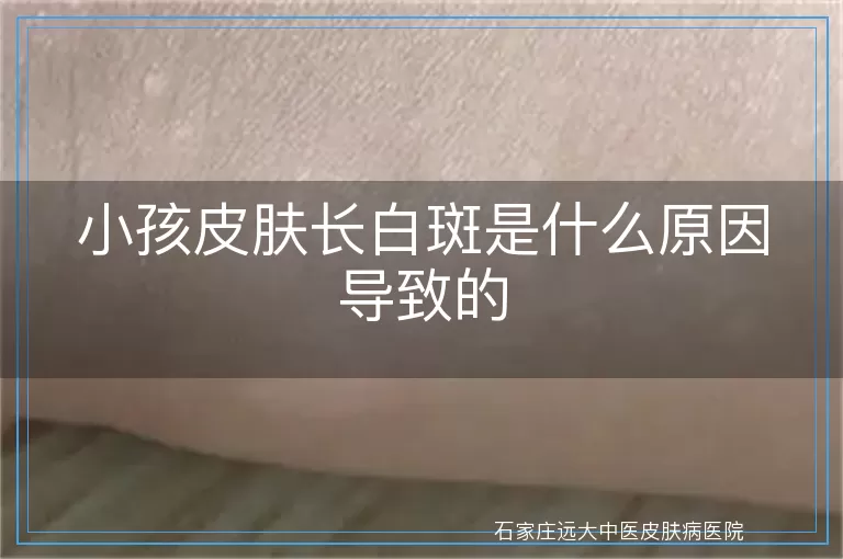 小孩皮肤长白斑是什么原因导致的