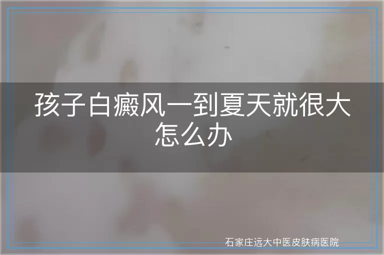 孩子白癜风一到夏天就很大怎么办