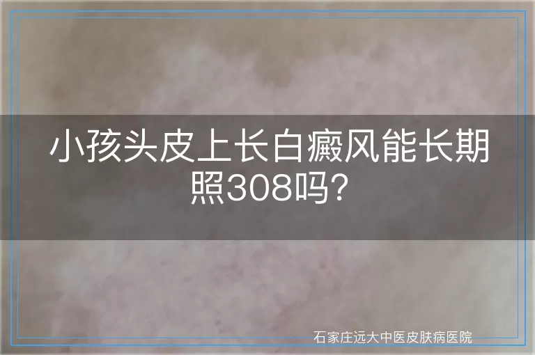小孩头皮上长白癜风能长期照308吗？