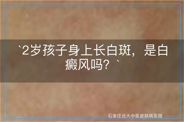2岁孩子身上长白斑，是白癜风吗？