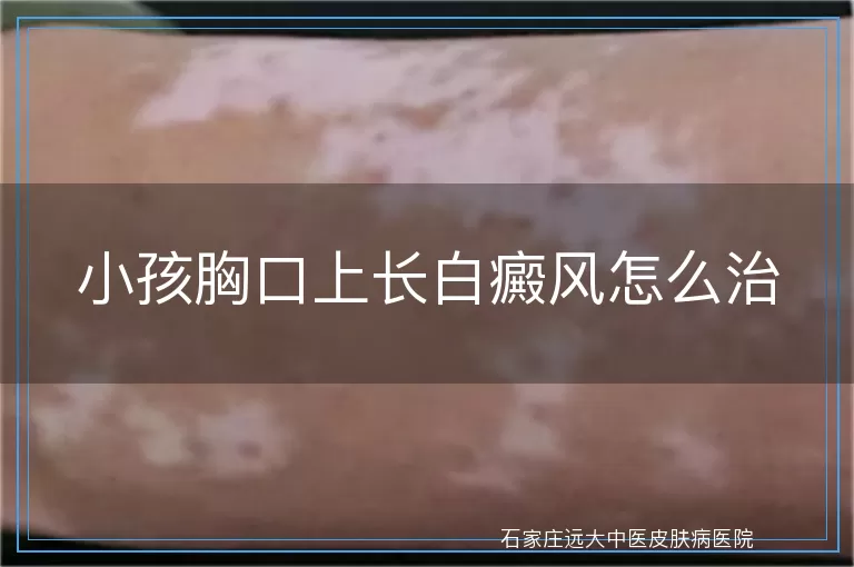 小孩胸口上长白癜风怎么治